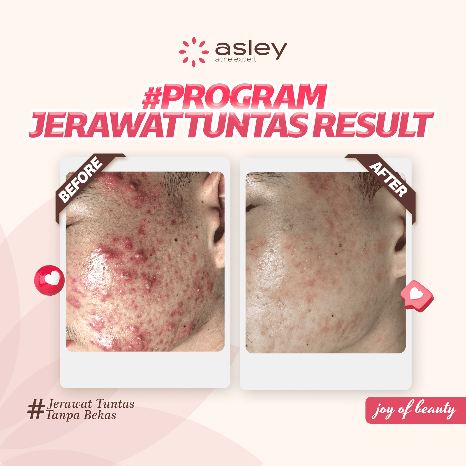 Jangan Panik, Ini Cara Jitu Menghilangkan Jerawat Batu!