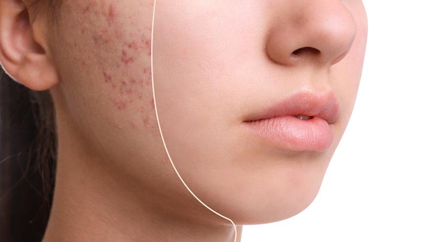 Rahasia Kulit Mulus : 10 Cara Ampuh Mengatasi Jerawat & Merawat Wajah agar Glowing