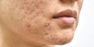 cara mengatasi jerawat muncul terus menerus