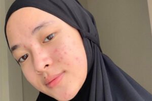 Penuh jerawat muka nisa sabyan