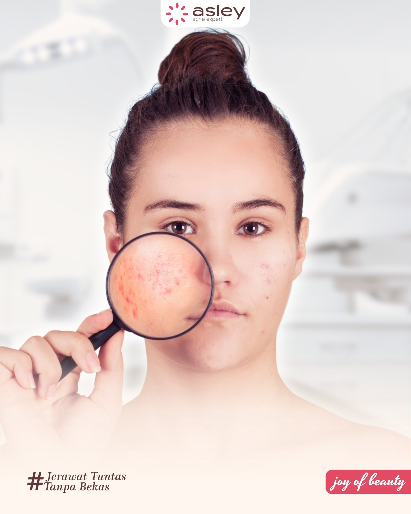 Apa perbedaan Jerawat Hormonal dan Jerawat Biasa yang Perlu Kamu Tahu!