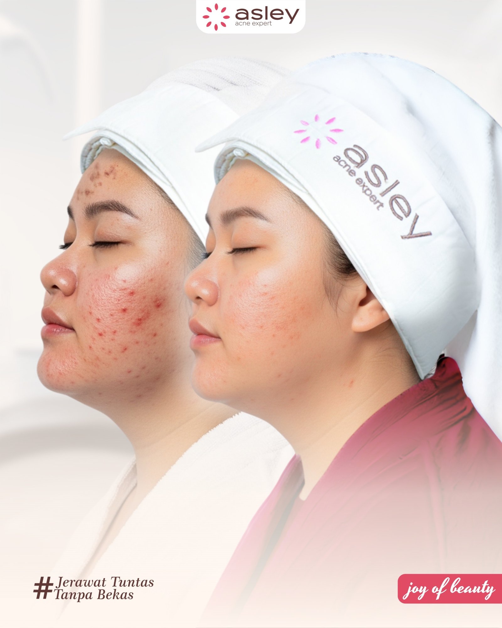 Cara Menghilangkan Bekas Jerawat Secara Alami dan Medis