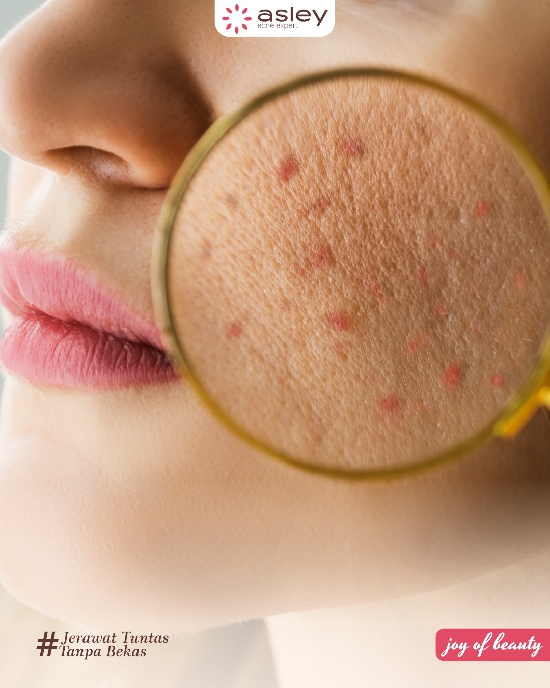 Skincare Malam Terbaik untuk Kulit Berjerawat