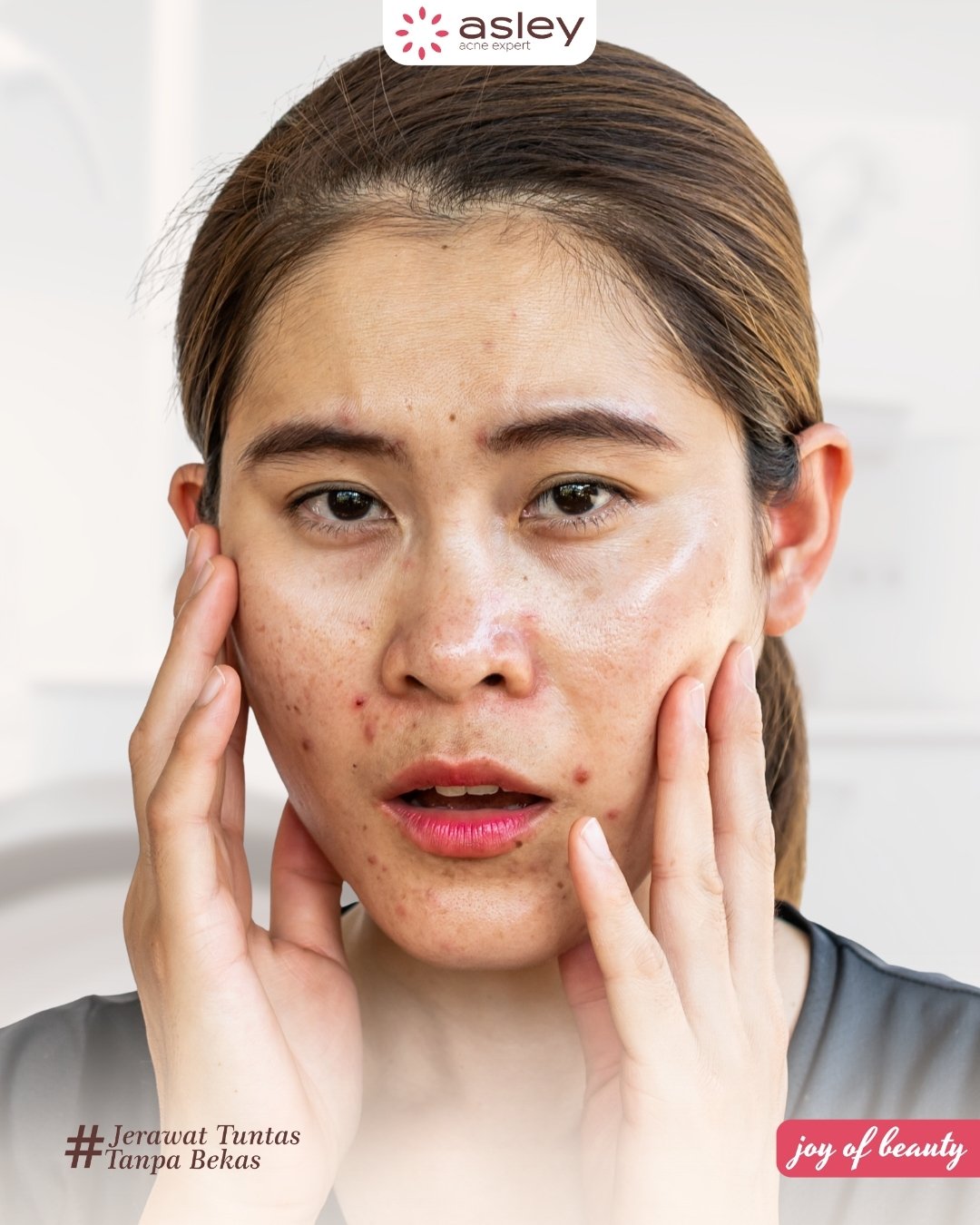 Solusi Ampuh Menghilangkan Bekas Jerawat Hitam di Wajah Secara Cepat dan Aman