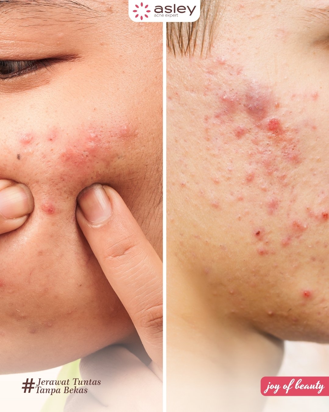 Cara Mencegah Jerawat Sebelum Muncul: Rahasia Kulit Bersih dari Dalam