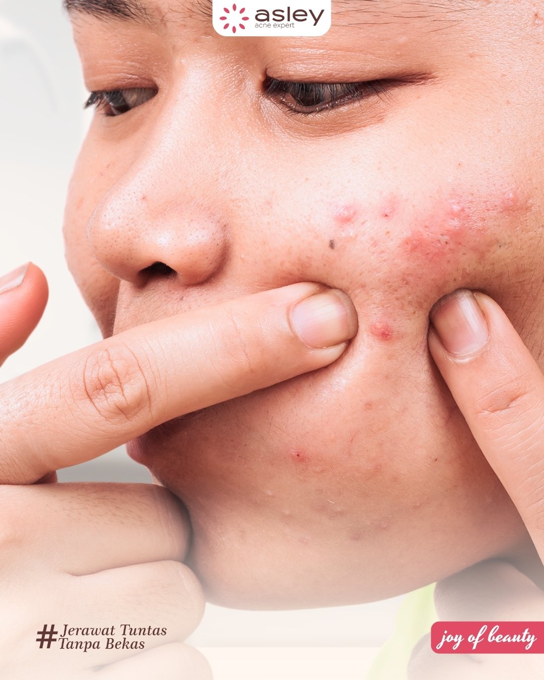 Kebiasaan Buruk yang Menyebabkan Jerawat Muncul Tanpa Disadari