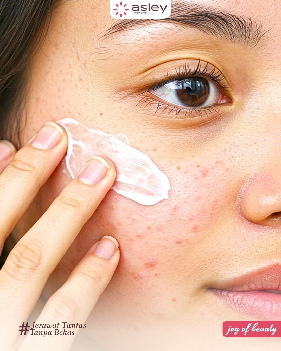 Rekomendasi Skincare untuk kulit berjerawat