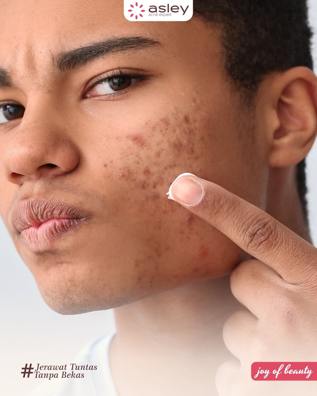 Pentingnya Sunscreen untuk Kulit Berjerawat