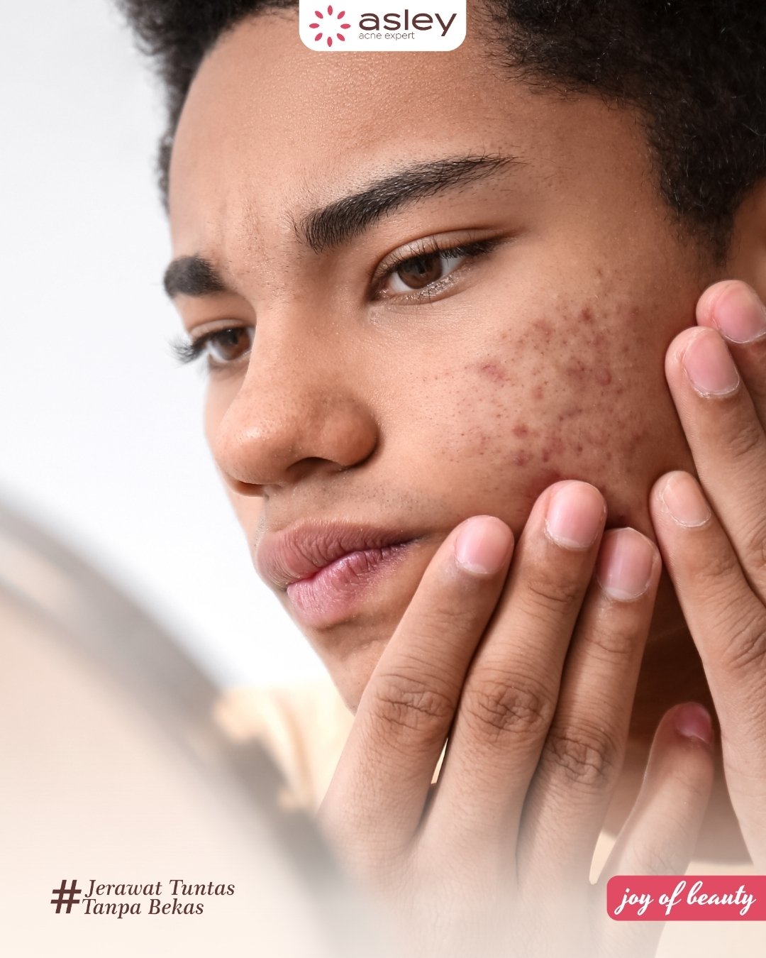 Cara Menghilangkan Jerawat Batu yang Meradang dan Sakit, Dijamin Lebih Cepat Reda