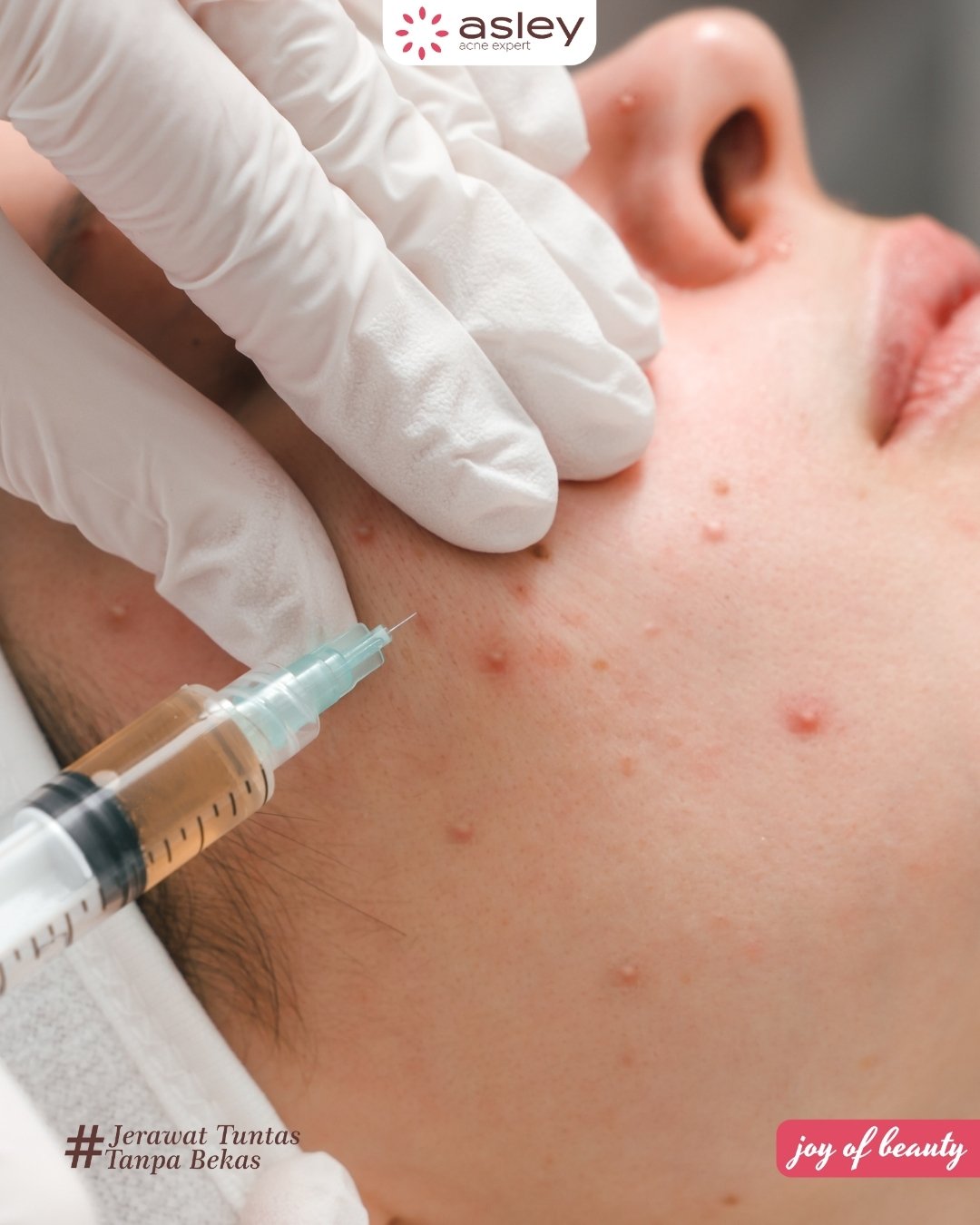 Tips Mengatasi Jerawat di Dagu yang Susah Hilang