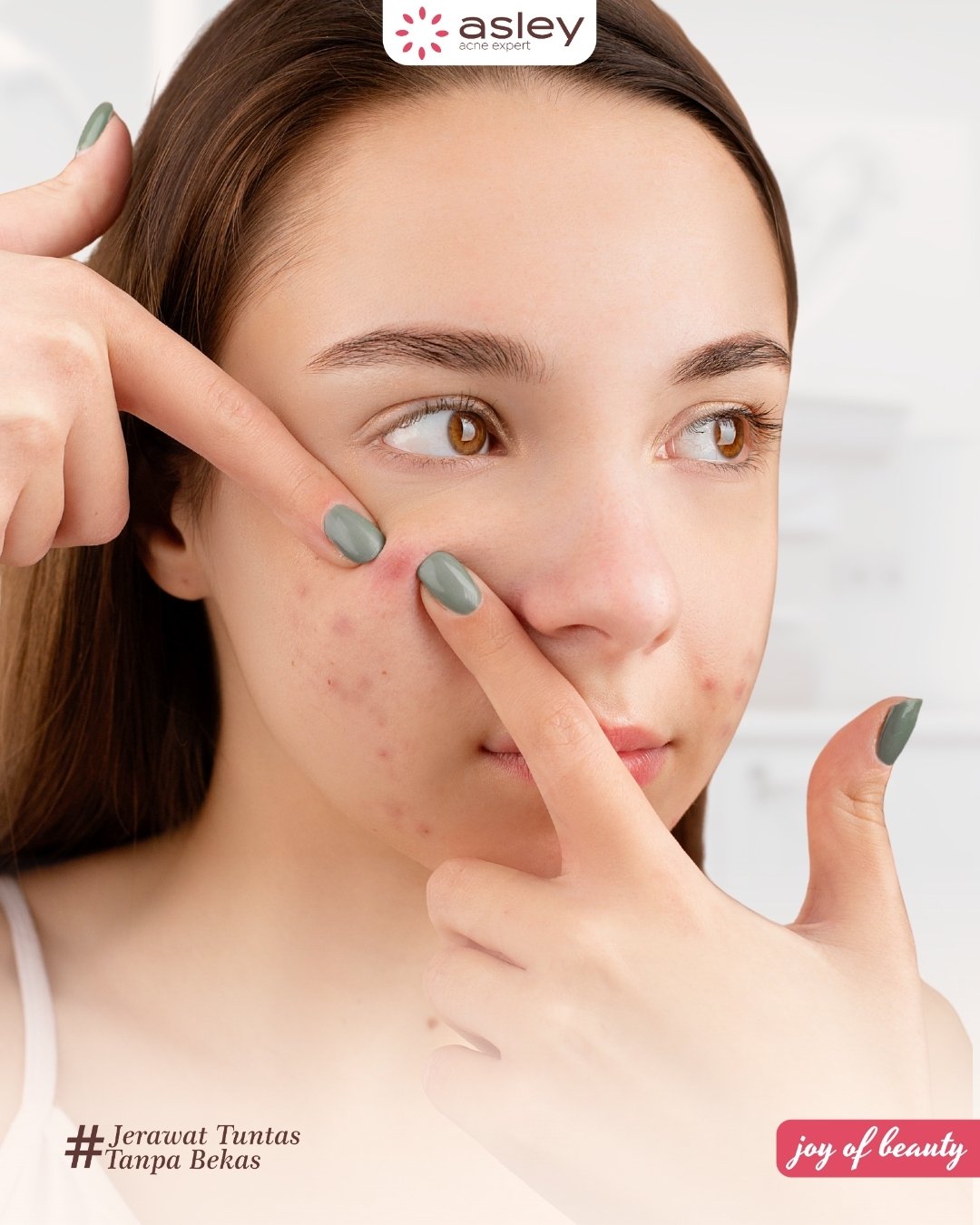 Mengapa Jerawat Bisa Membuat Tidak Percaya Diri? Simak Penjelasannya