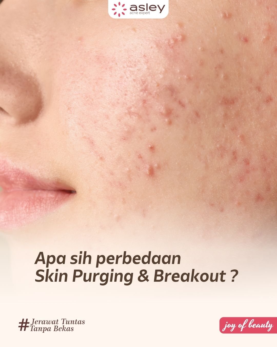 Fenomena “Skin Purging” yang Lagi Viral: Bedanya dengan Breakout dan Cara Mengatasinya