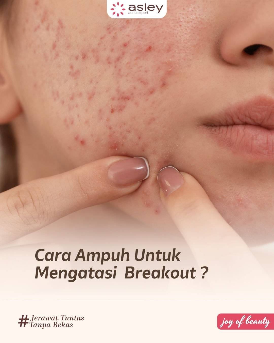 Breakout Akibat Cuaca Panas Ekstrem? Ini Penyebab, Tanda, dan Solusi Mengatasinya