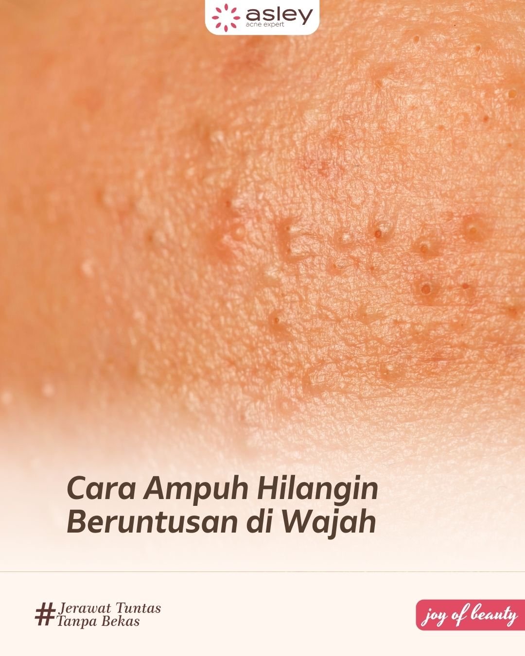 Cara Menghilangkan Bruntusan dengan Cepat dan Aman Tanpa Bikin Iritasi