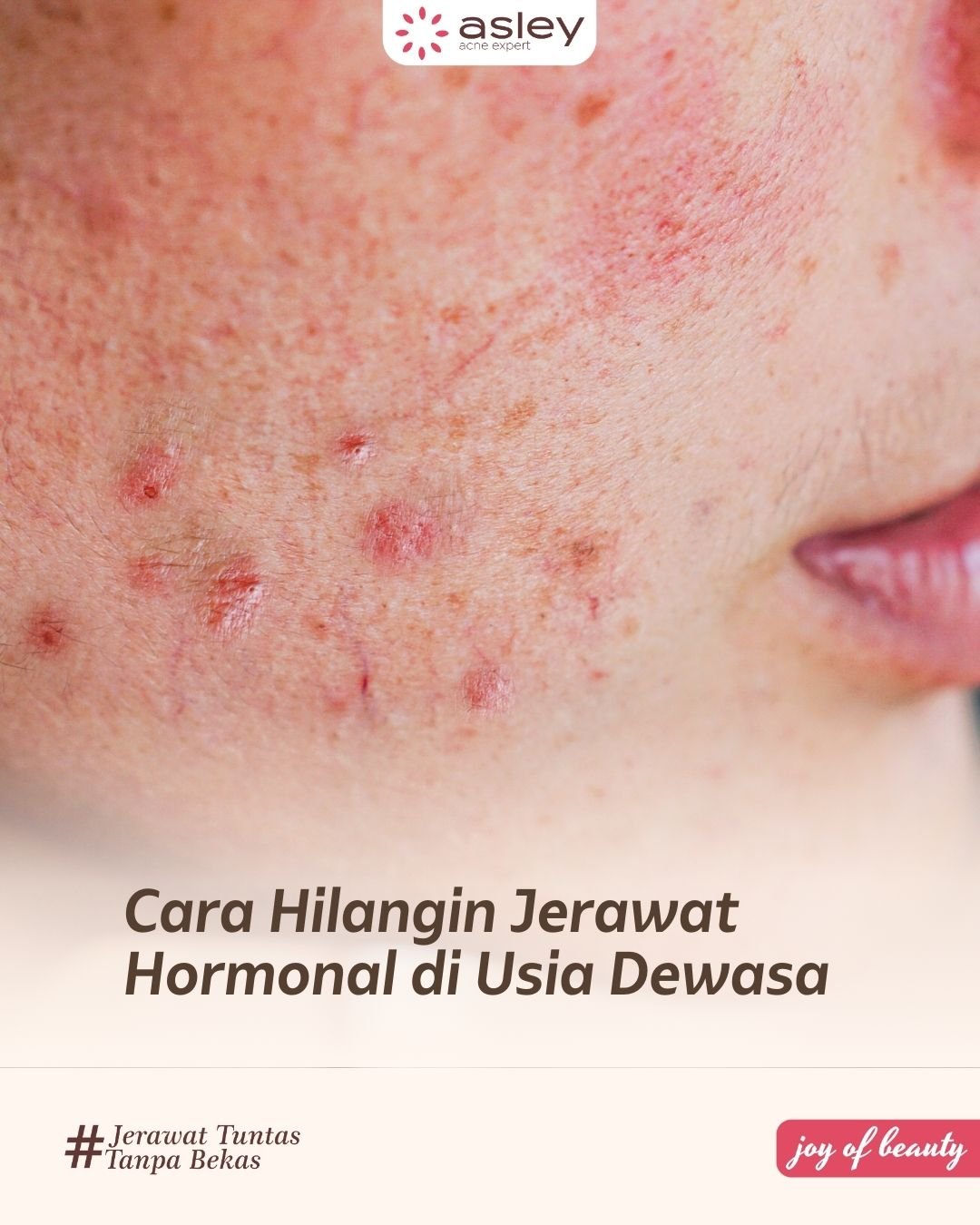 Jerawat Hormonal: Penyebab, Ciri-Ciri, dan Cara Mengatasinya Agar Tidak Datang Kembali