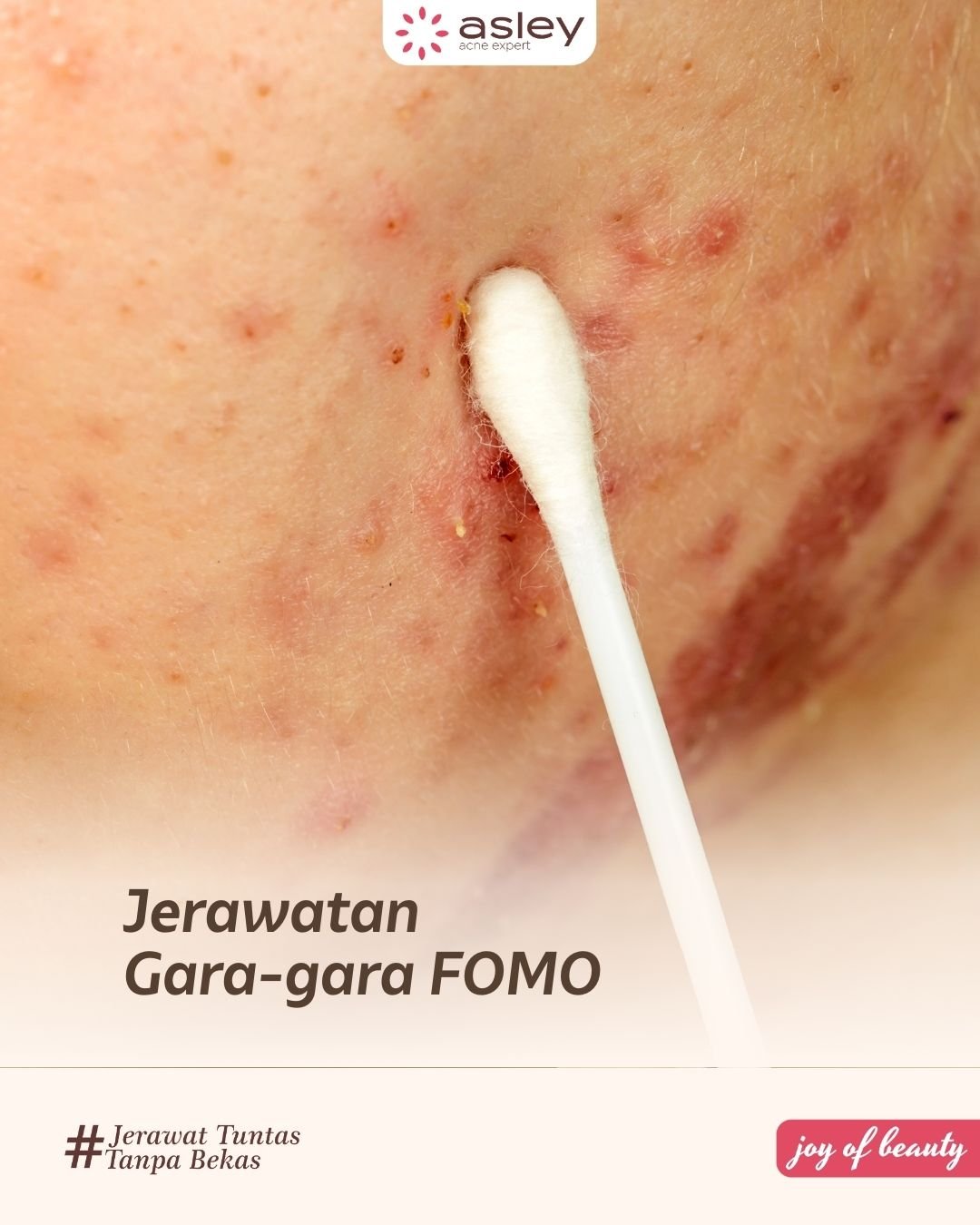Skin Barrier Rusak Penyebab Jerawat Semakin Parah? Ini Cara Memperbaikinya dengan Aman dan Efektif