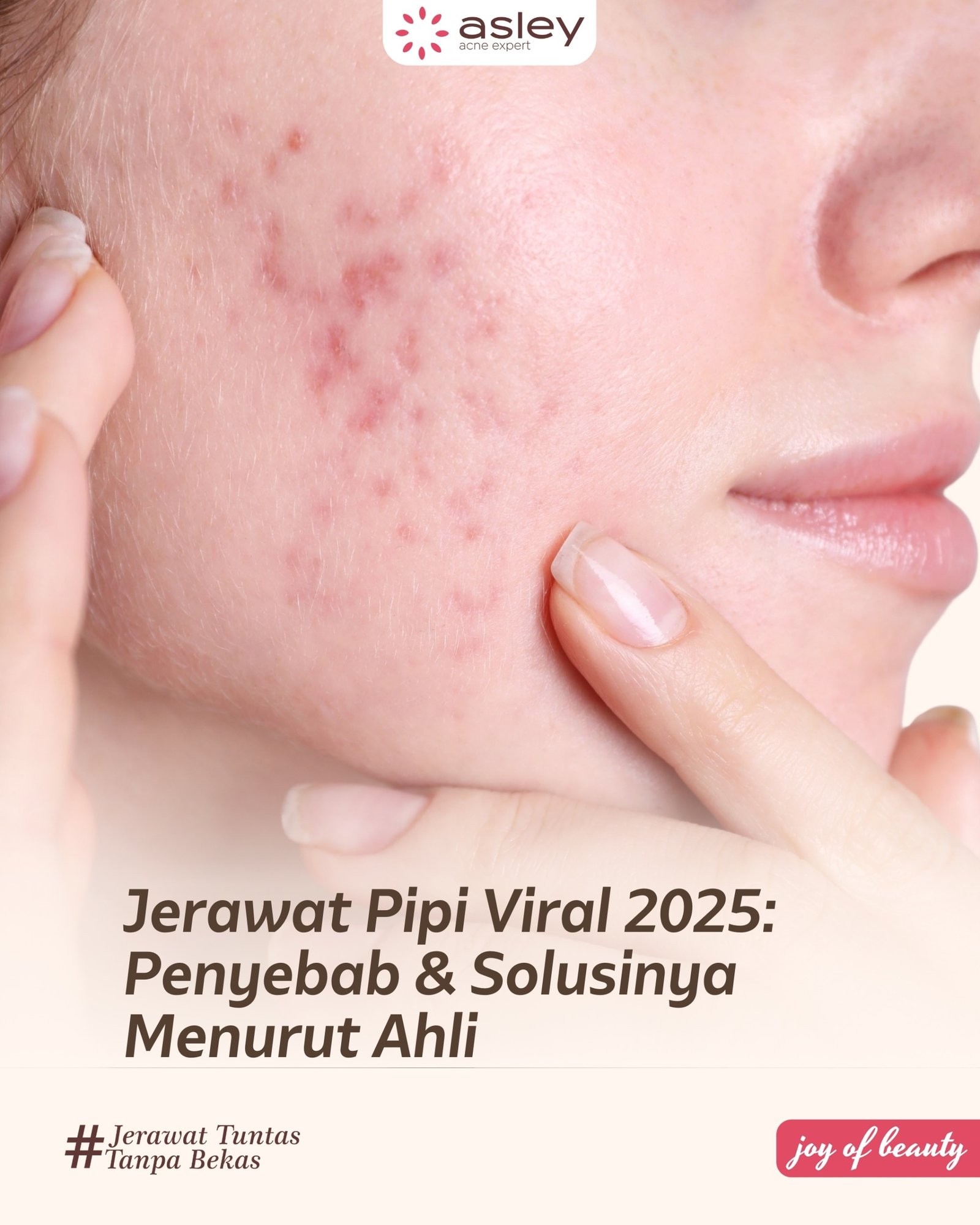 Jerawat Pipi Viral 2025: Penyebab, Kebiasaan Pemicu, dan Solusi Terbaik Menurut Ahli