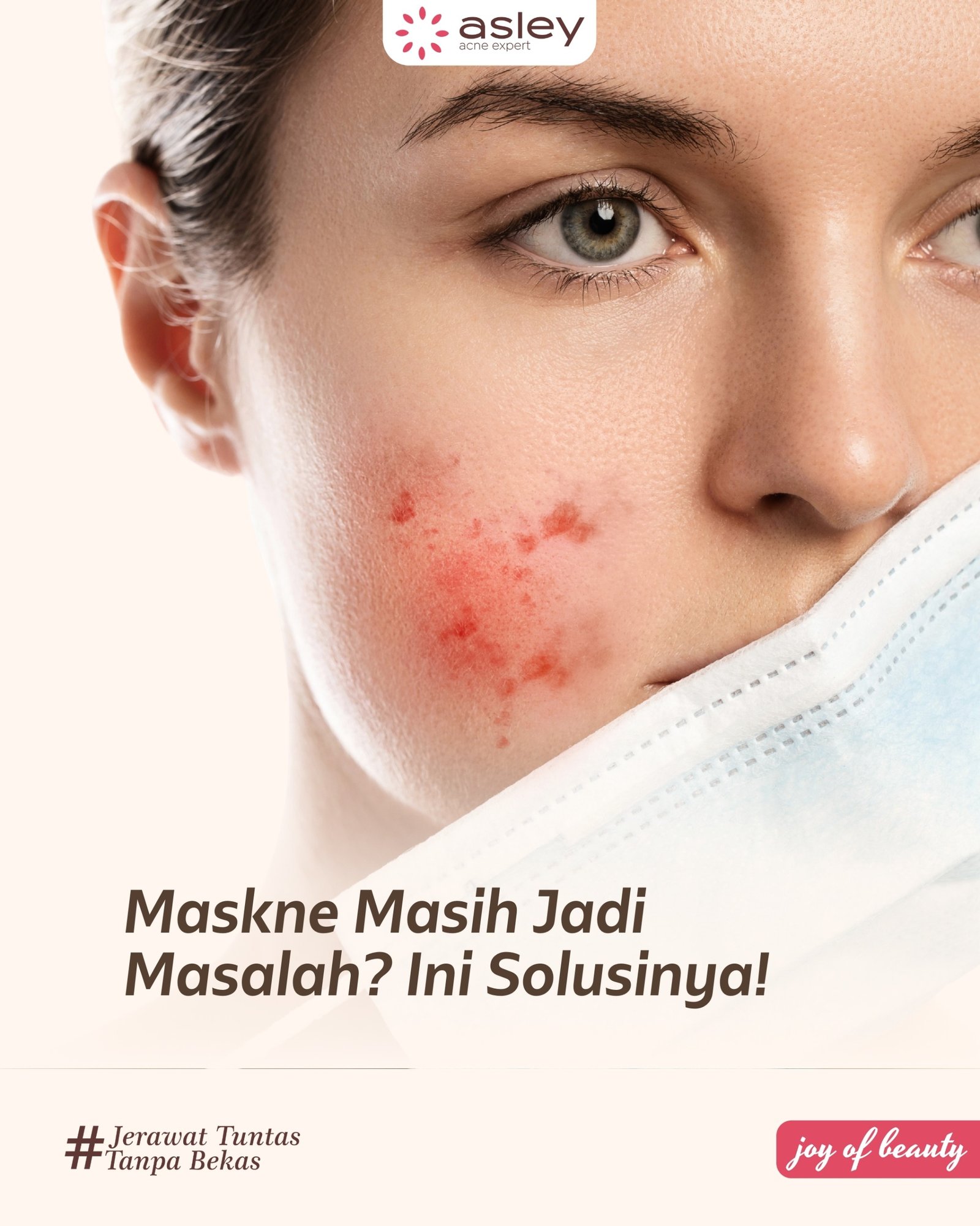 Maskne Masih Jadi Masalah? Begini Cara Mengatasinya Secara Tuntas!