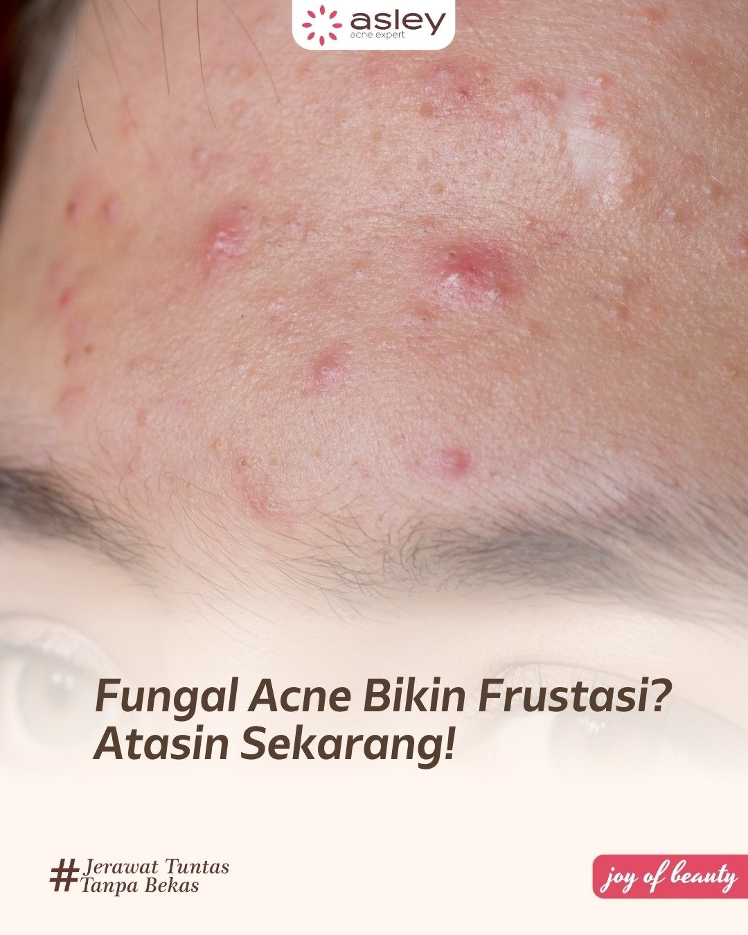 Fungal Acne Bikin Frustrasi? Kenali Tanda, Penyebab, dan Cara Mengatasinya dengan Tepat!