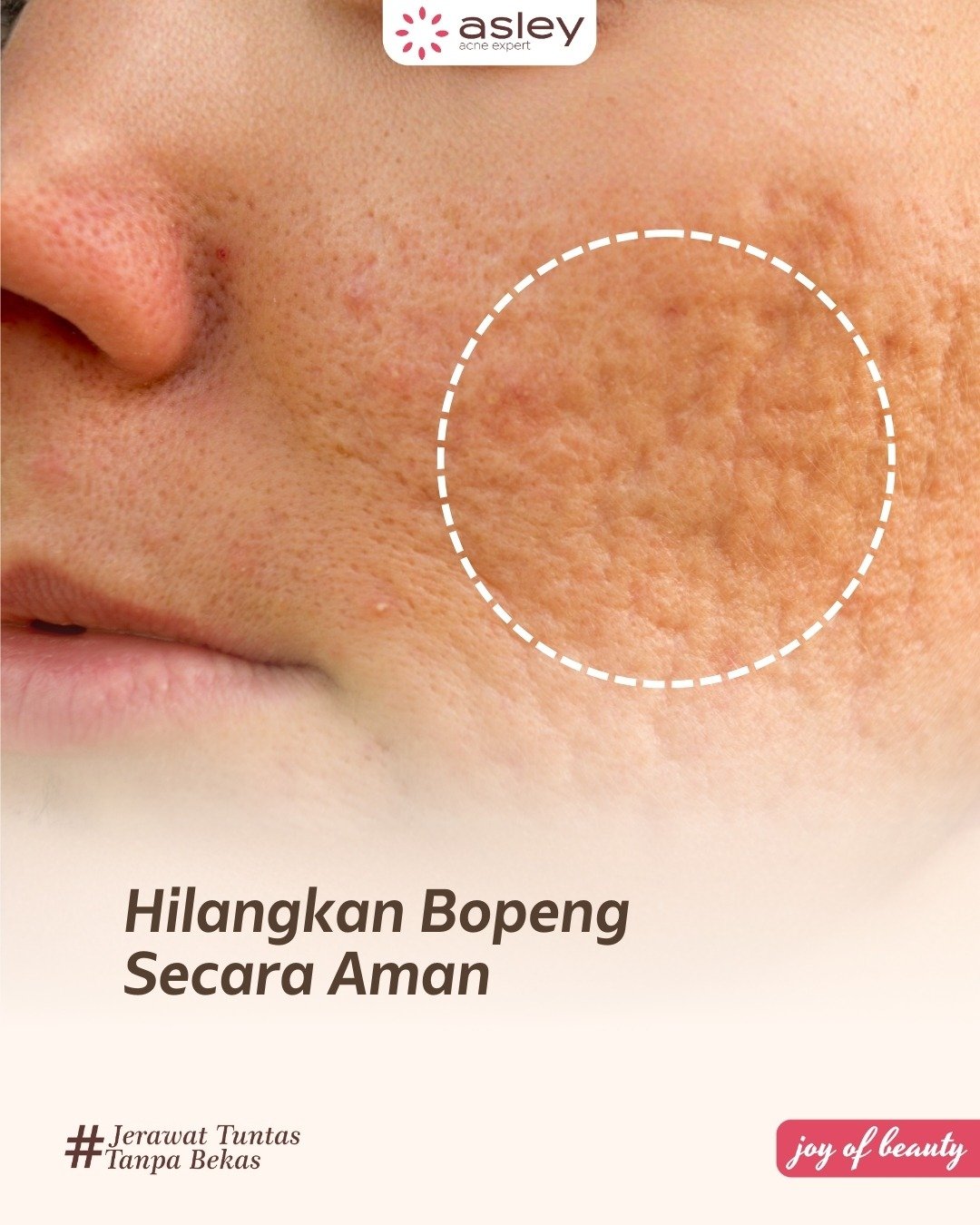 Cara Menghilangkan Bopeng Jerawat Secara Permanen: Panduan Lengkap Perawatan di Asley Acne Expert & Asley Clinic Karawang