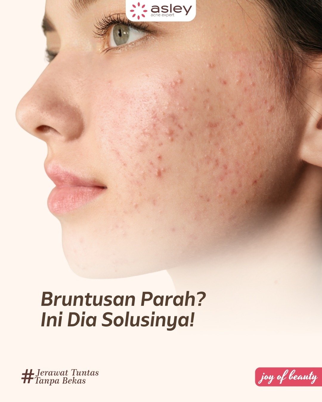 Cara Mengatasi Bruntusan Membandel dengan Cepat: Penyebab, Perawatan, dan Treatment Terbaik