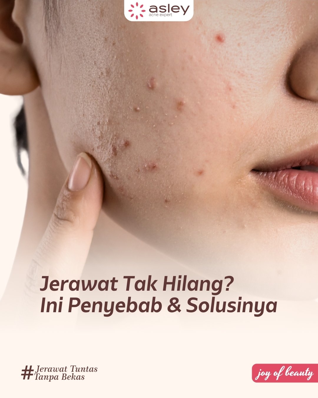 Jerawat Tidak Kunjung Hilang? Ini Penyebab Utama dan Solusi Efektif untuk Kulit Lebih Sehat