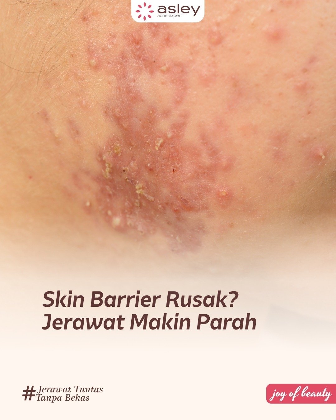 Skin Barrier Rusak Bikin Jerawat Makin Parah? Ini Tanda, Penyebab, dan Cara Memperbaikinya