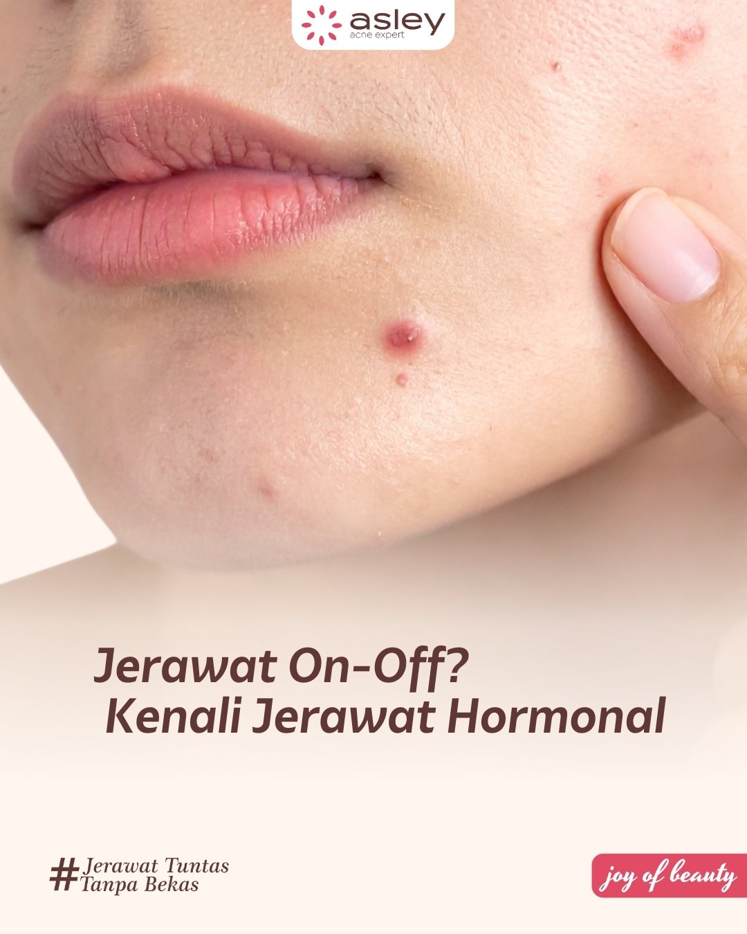 Jerawat On-Off Tak Kunjung Sembuh? Ini Penyebab, Ciri Jerawat Hormonal, dan Solusi Tepatnya