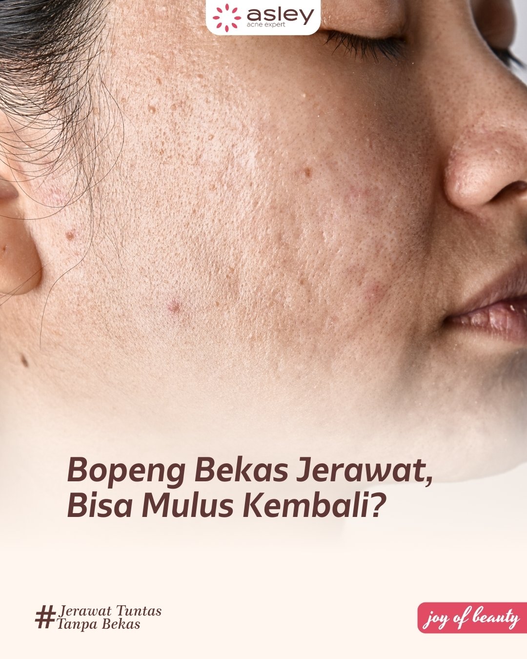 Bopeng Bekas Jerawat: Mengapa Terjadi dan Bisakah Kembali Mulus?