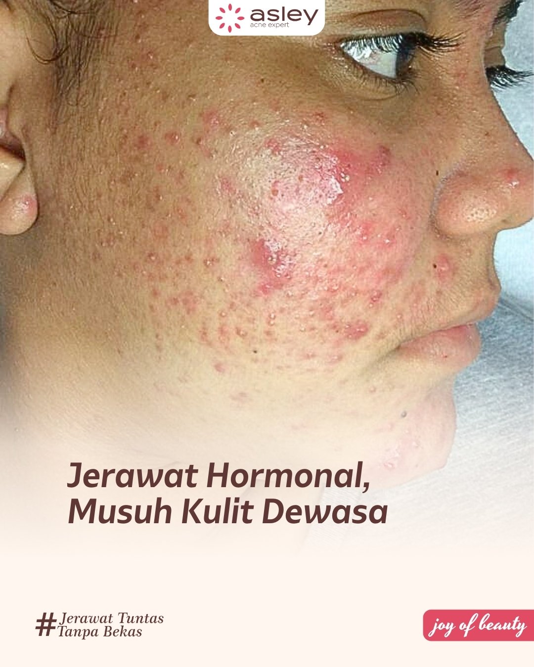 Jerawat Hormonal: Penyebab Utama Jerawat Dewasa yang Sering Kambuh