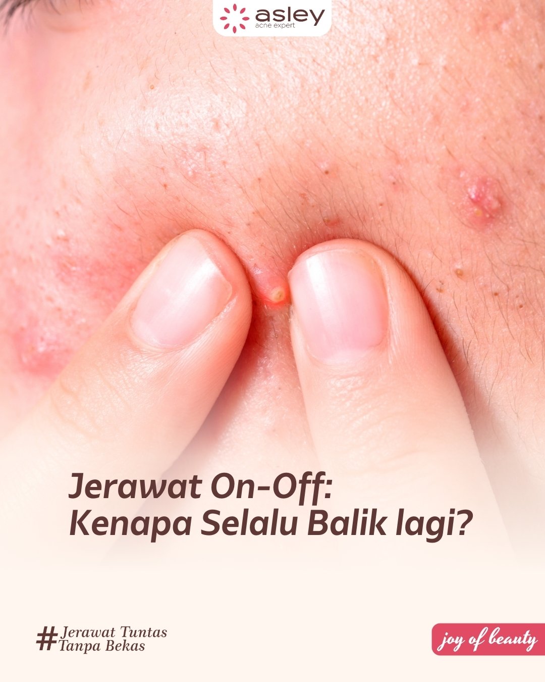 Jerawat Kemerahan Tidak Kunjung Hilang? Kenali Penyebab, Cara Mengatasi, dan Treatment Terbaik di Asley Acne Expert & Asley Clinic Karawang