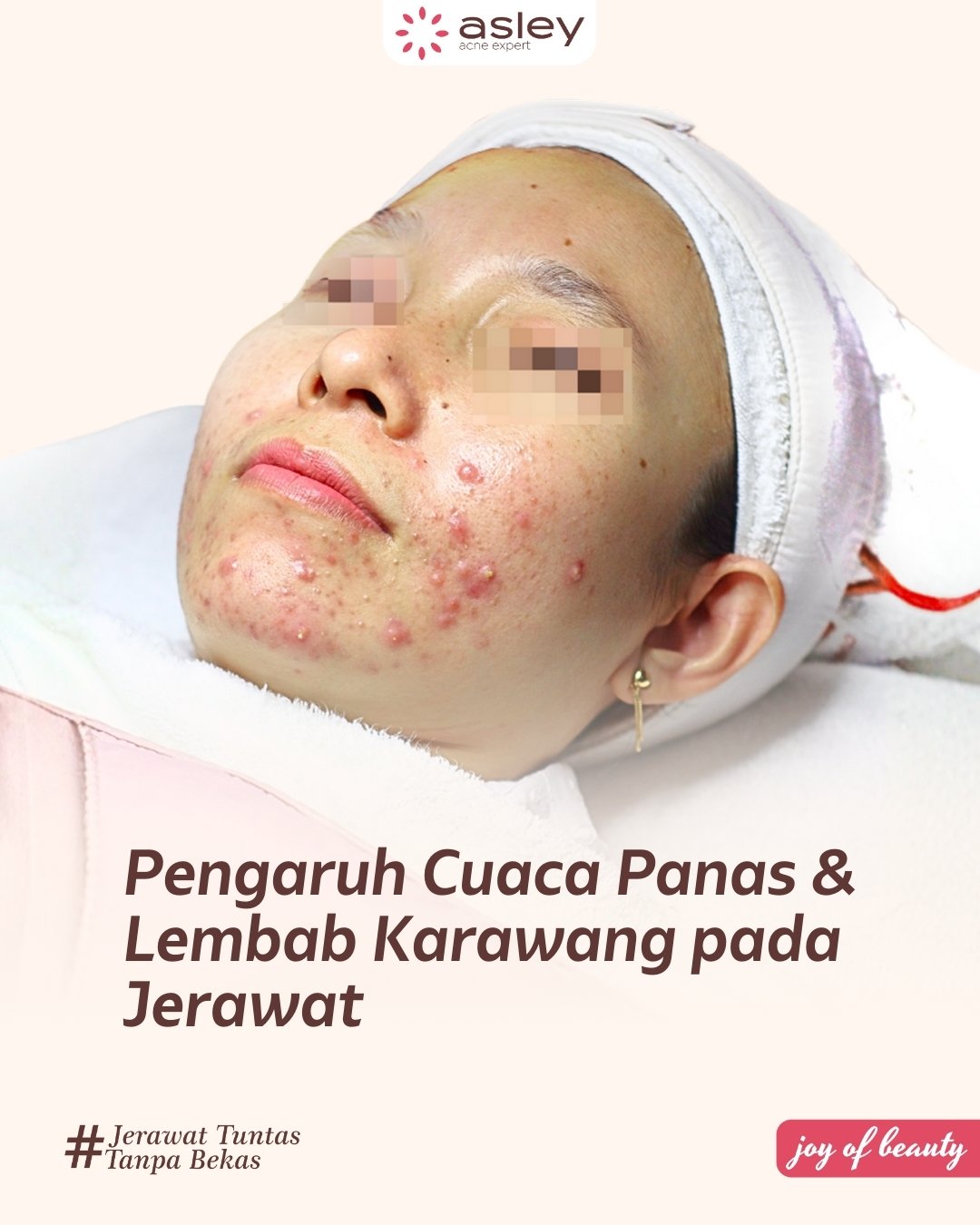 Pengaruh Cuaca Panas dan Lembab Karawang terhadap Kulit Berjerawat