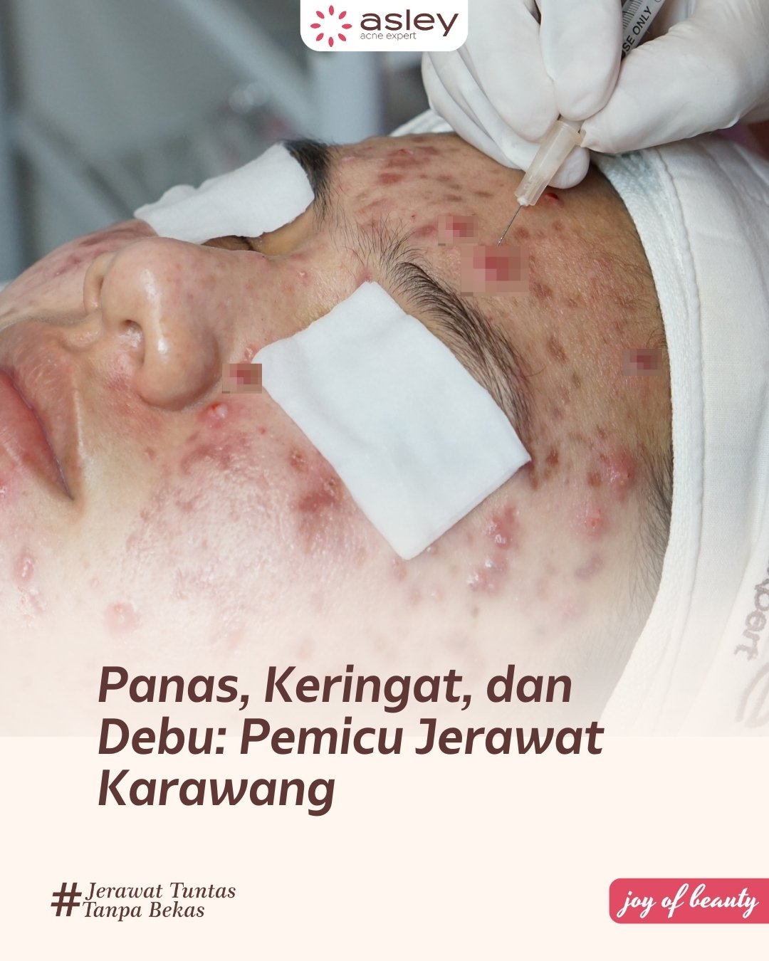 Kombinasi Panas, Keringat, dan Debu: Lingkaran Setan Jerawat Karawang